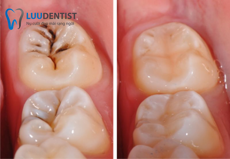Trám bít hố rãnh mặt nhai ngừa sâu răng hiệu quả